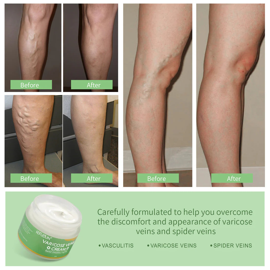 Varicose Veins Cream