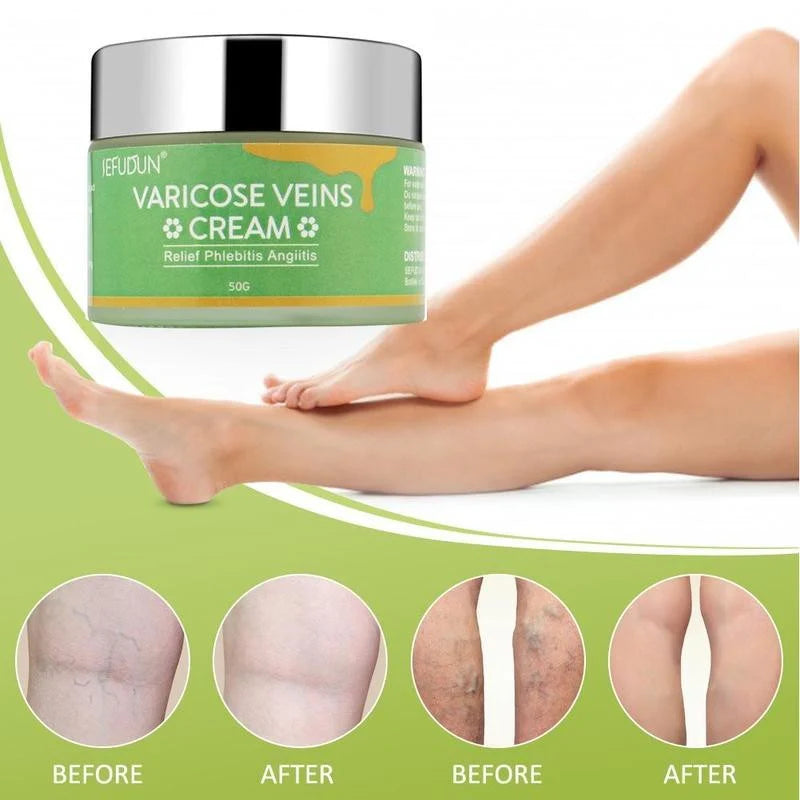 Varicose Veins Cream